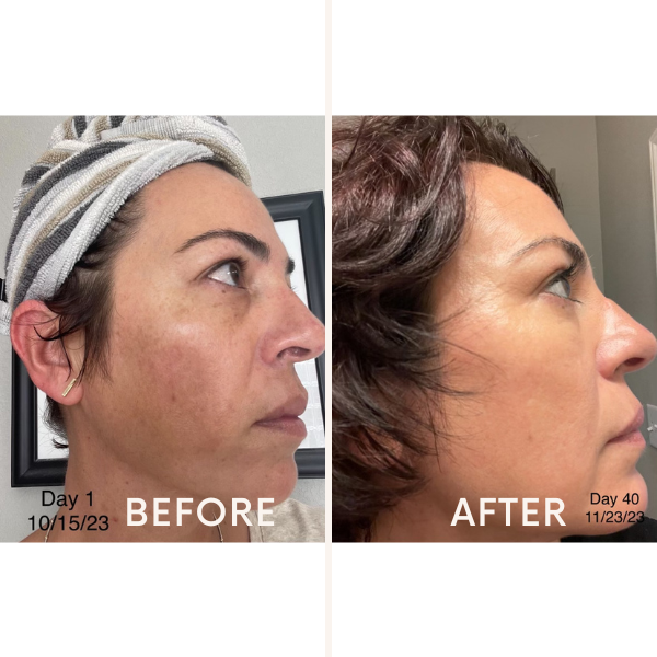 Discoloration Fade Wand - Skincare Junkie