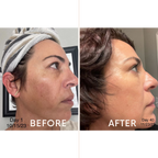 Discoloration Fade Wand - Skincare Junkie