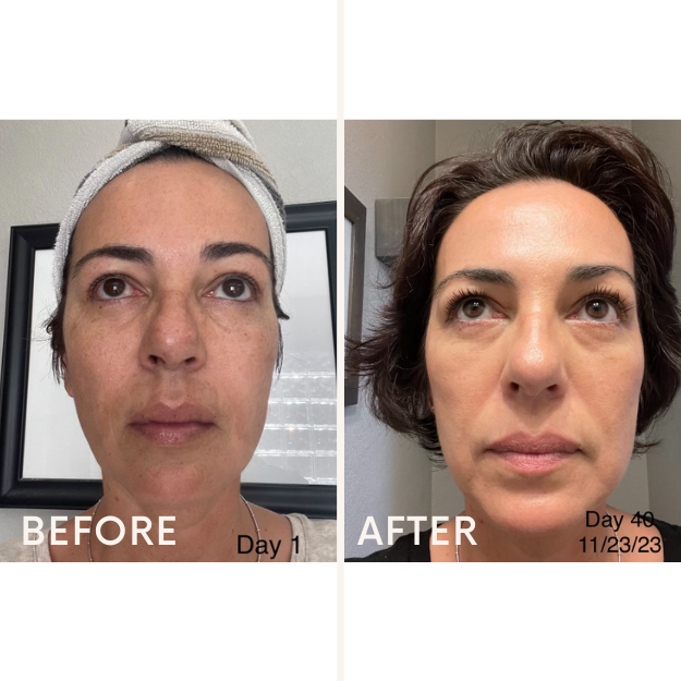 Discoloration Fade Wand - Skincare Junkie