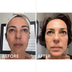 Discoloration Fade Wand - Skincare Junkie